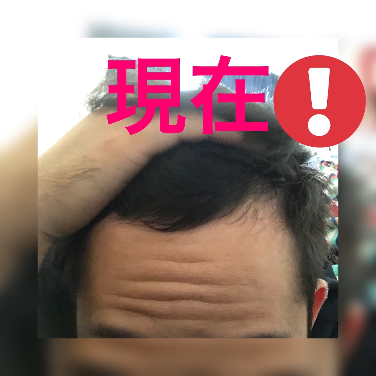 薄毛でお悩みの方。格安！私の成功法お教えします 若禿の私が実際に行い成功した、格安な方法お教えします！ イメージ4