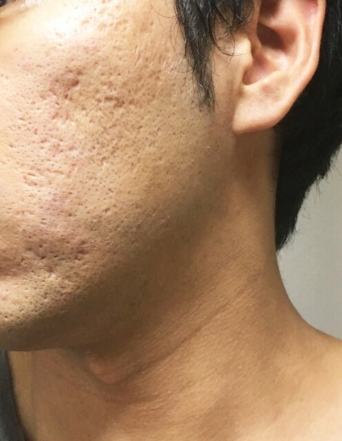 毛穴を閉じて潤いを取り戻す方法を教えます 「はぁ、最悪。。」朝起きて鏡を見た瞬間に映る自分の肌 イメージ7