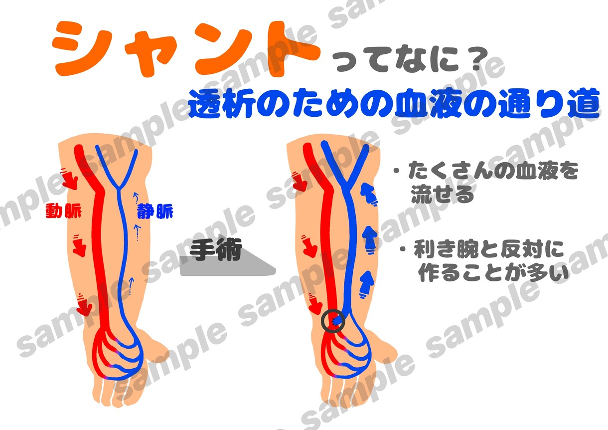透析患説明がラクになる図解４枚セット作成します ３秒で伝わる！患者説明を楽にする図解 イメージ3