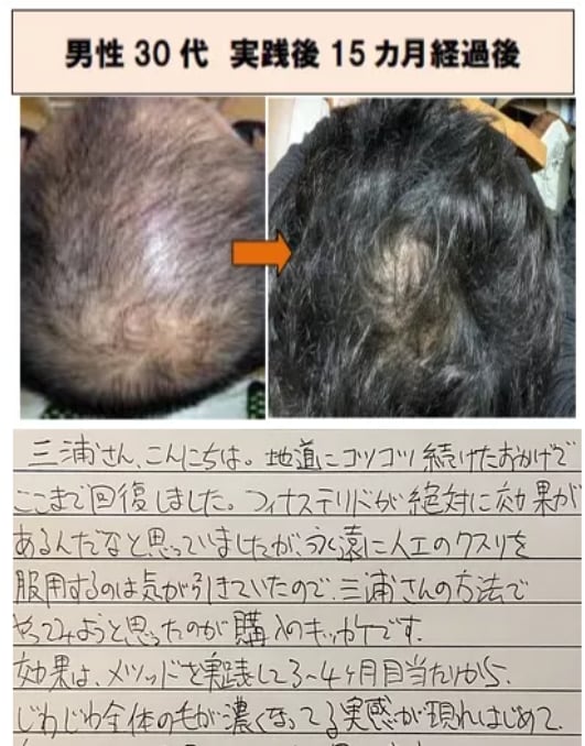 ミノキシジル無しでこの効果！写真のように改善します いつまでミノタブ、フィンペシアの副作用で消耗してるんですか？ イメージ3