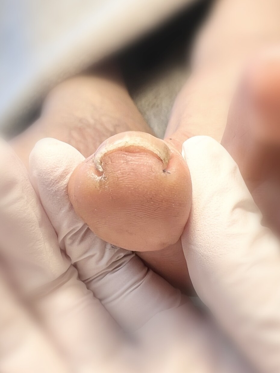 巻き爪の対処法お伝えします 看護師・巻き爪経験者・皮膚科勤務経験あり・巻き爪補正店 イメージ2