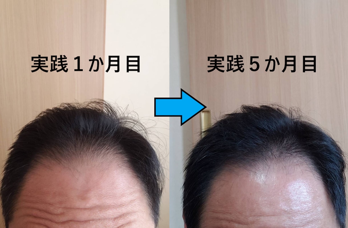 ミノキシジル無しでこの効果！写真のように改善します いつまでミノタブ、フィンペシアの副作用で消耗してるんですか？ イメージ2