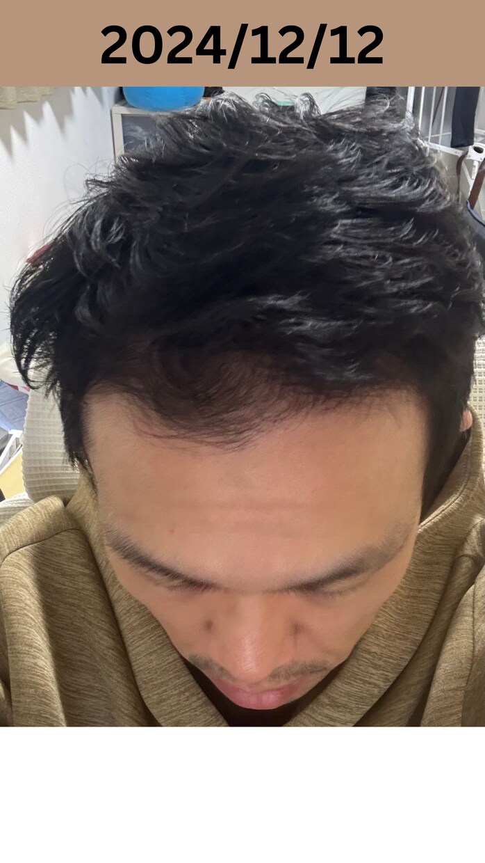 薄毛・AGAは改善できる！私が改善した方法教えます 私の実体験です。画像は私自身です！ イメージ2