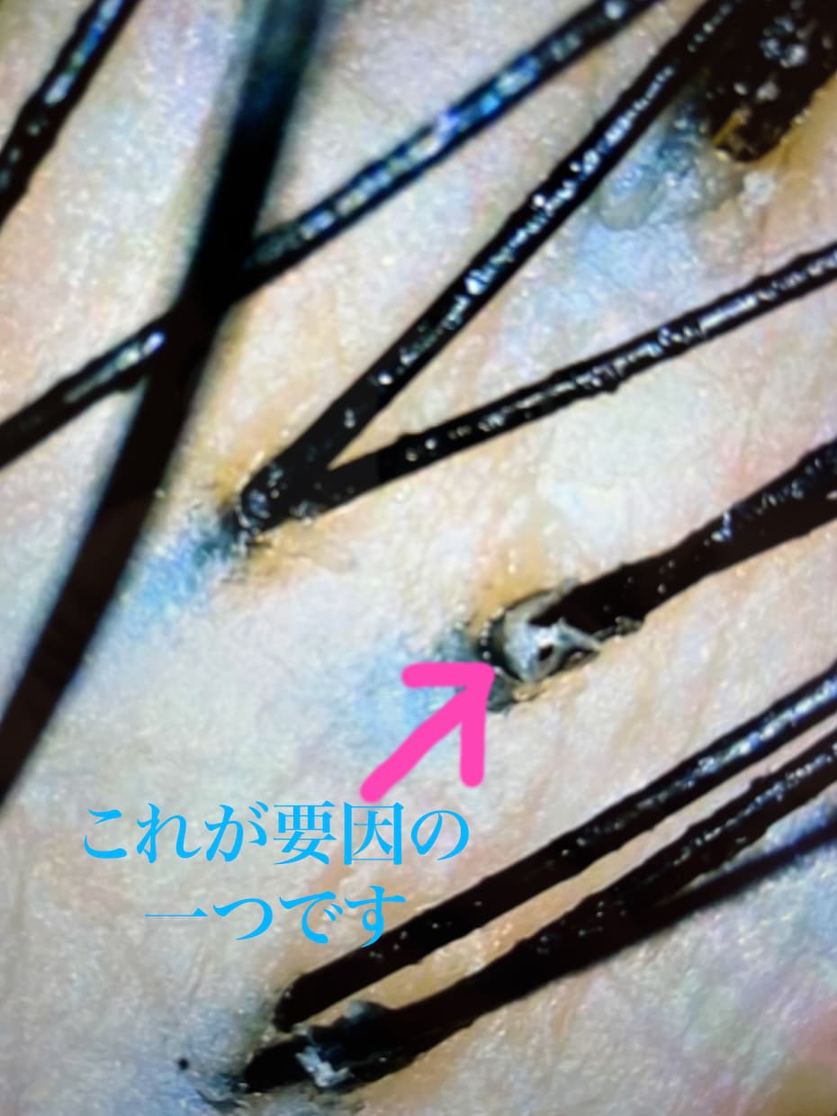 頭皮のかゆみ、フケのお悩み解消伺います 年間1000人の頭皮を診断している美容師です イメージ3