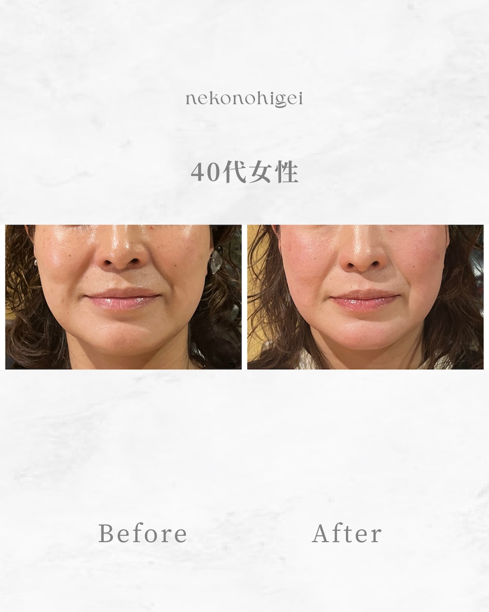 顔に鍼を打ってるだけ”から卒業できます お客様に変化を実感させる美容鍼の基礎からの打ち方 イメージ6
