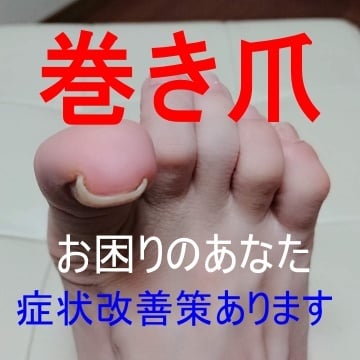 巻き爪でお困りの方へ、わたしの対処法を紹介します 以前は両足の親指が化膿していましたが今は好転しかなり歩けます イメージ2