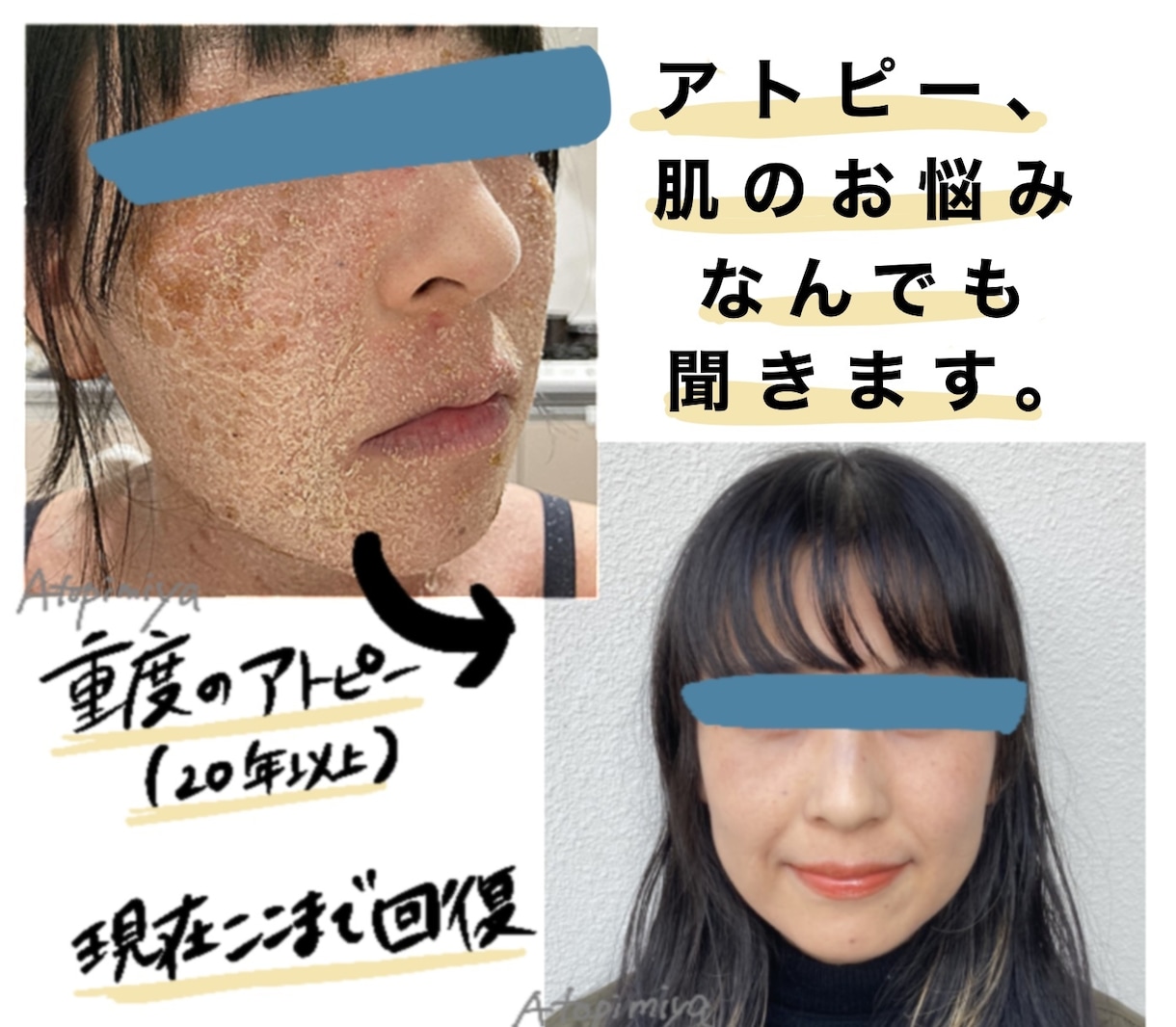 アトピーや敏感肌でお悩みの方、お話聞きます 食事、スキンケア、生活についてのお悩みなんでも イメージ1