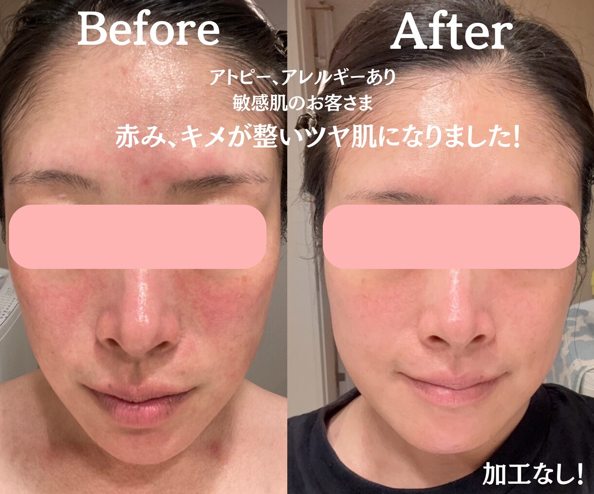 チャットで肌改善 個別相談（最大3日間）ができます 肌は十人十色！目指すはノーファンデ！ イメージ3