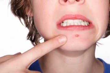 ニキビのお悩み解決します 間違ったケアをしていませんか？ イメージ1