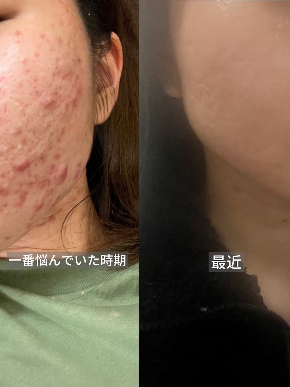 皮膚科で治らないニキビを改善した方法をお伝えします 生活習慣を見直して、ニキビができにくい肌を目指しませんか？ イメージ1