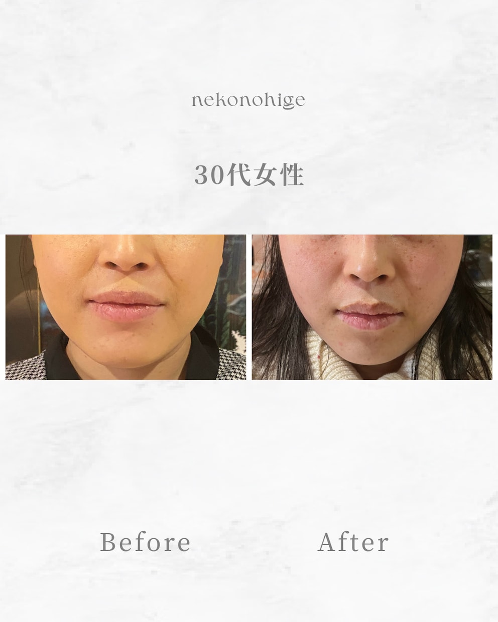 顔に鍼を打ってるだけ”から卒業できます お客様に変化を実感させる美容鍼の基礎からの打ち方 イメージ2