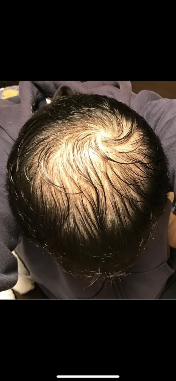 薄毛の方に朗報。私が改善した体験談をお伝えします 男性専用となります。特に頭頂部が薄い方はご相談下さい。 イメージ1
