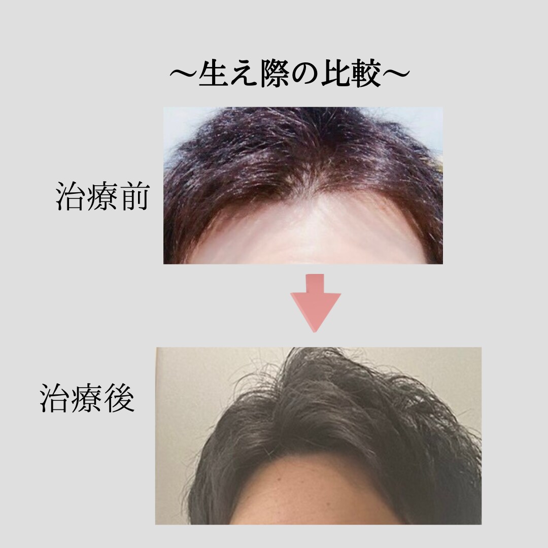 薄毛に悩む方に！薄毛対策教えます 〜思ってたよりも安く薄毛対策出来ます〜 イメージ2