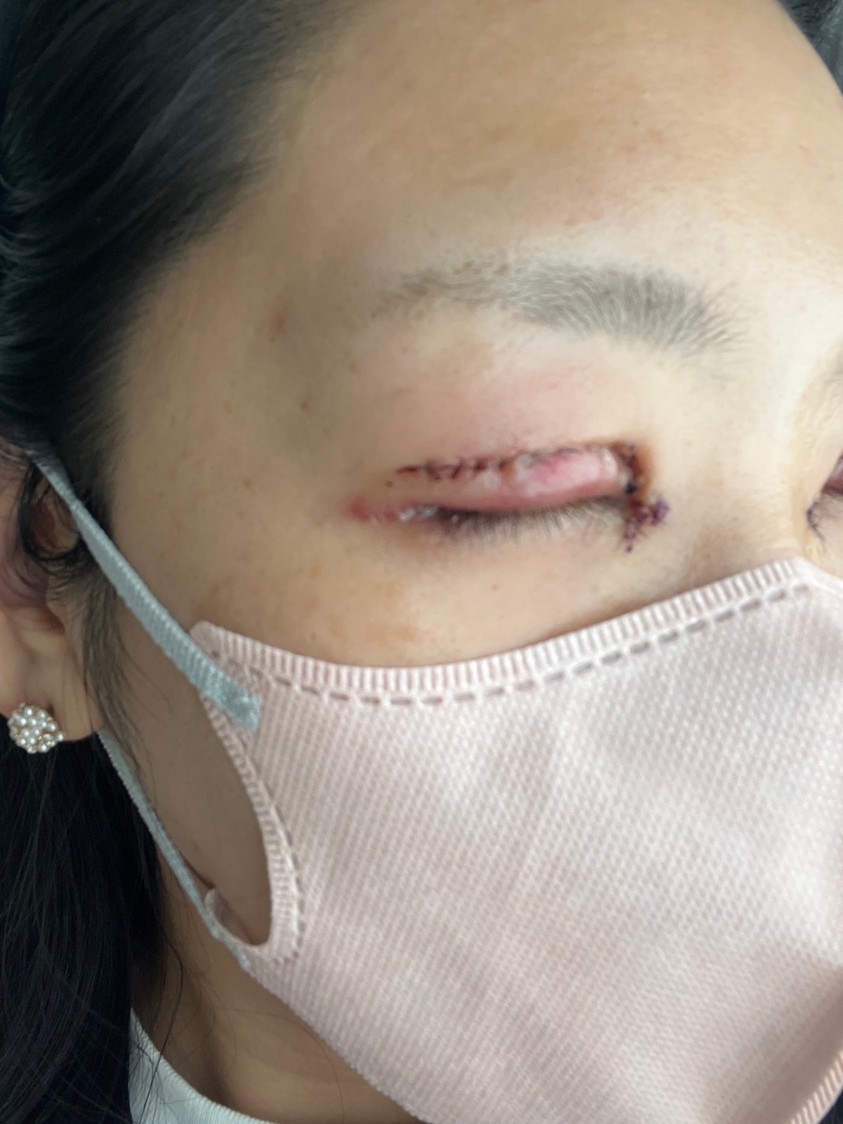 眼瞼下垂（二重整形）手術後の合併症　後遺症相談ます 2年半の生活変化と私の乗り越え方 イメージ2