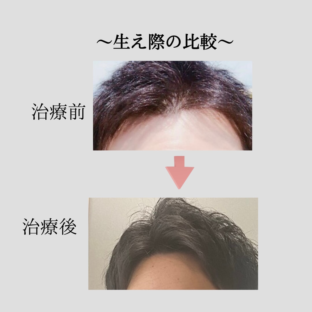 大手発毛クリニックはまだ止めて！薄毛治療法教えます 〜大手発毛クリニックはこの格安薄毛治療法を試してから〜 イメージ2