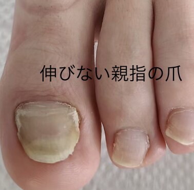 巻き爪様子がおかしい爪　足の相談お受けします 病院はコワい気になる足の事写真を送るだけで改善したい！ イメージ5