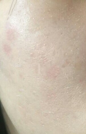 家でクレーターを完全に治す方法教えます 肌の深いクレーターを短期間で治す方法教えます！ イメージ2