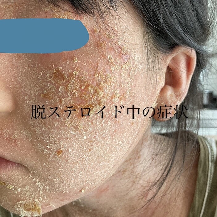 アトピーや敏感肌でお悩みの方、お話聞きます 食事、スキンケア、生活についてのお悩みなんでも イメージ2