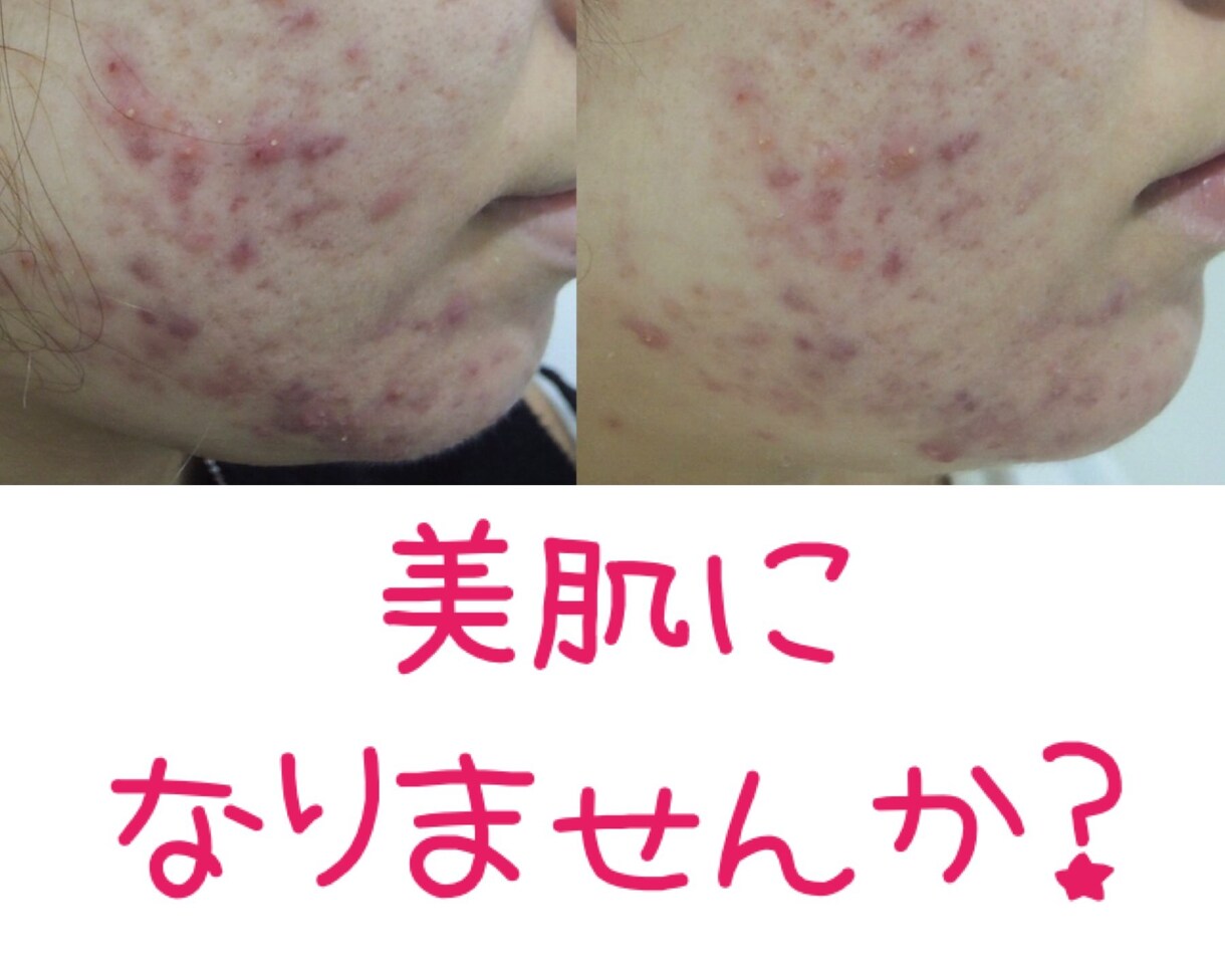 限定20名☆肌質にあったスキンケアお伝えします 500人以上の肌を肌専門サロンにてカウンセリング実績 イメージ3