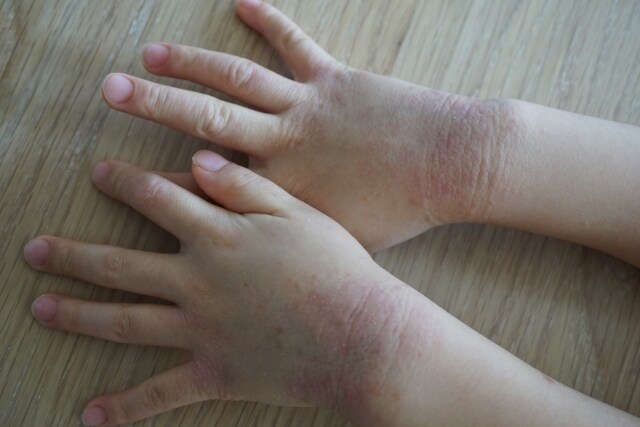 アレルギー克服体験からアトピーの治し方を提供します 薬を使わず、原因は何か。常識を疑い・食生活改善を提案します。 イメージ9
