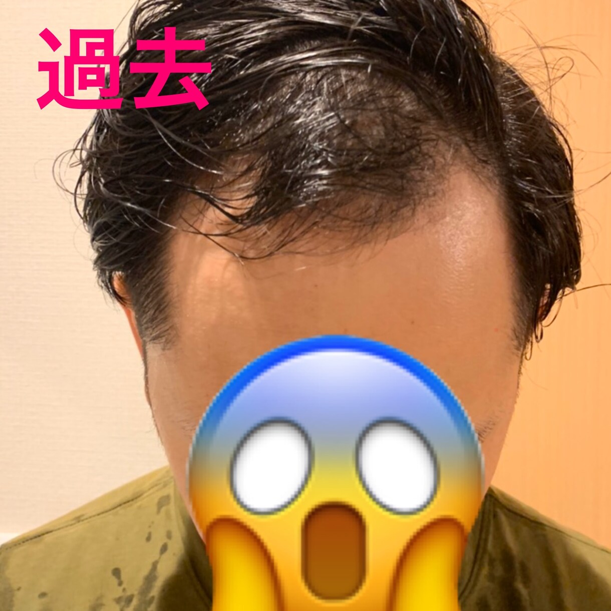 薄毛でお悩みの方。格安！私の成功法お教えします 若禿の私が実際に行い成功した、格安な方法お教えします！ イメージ3