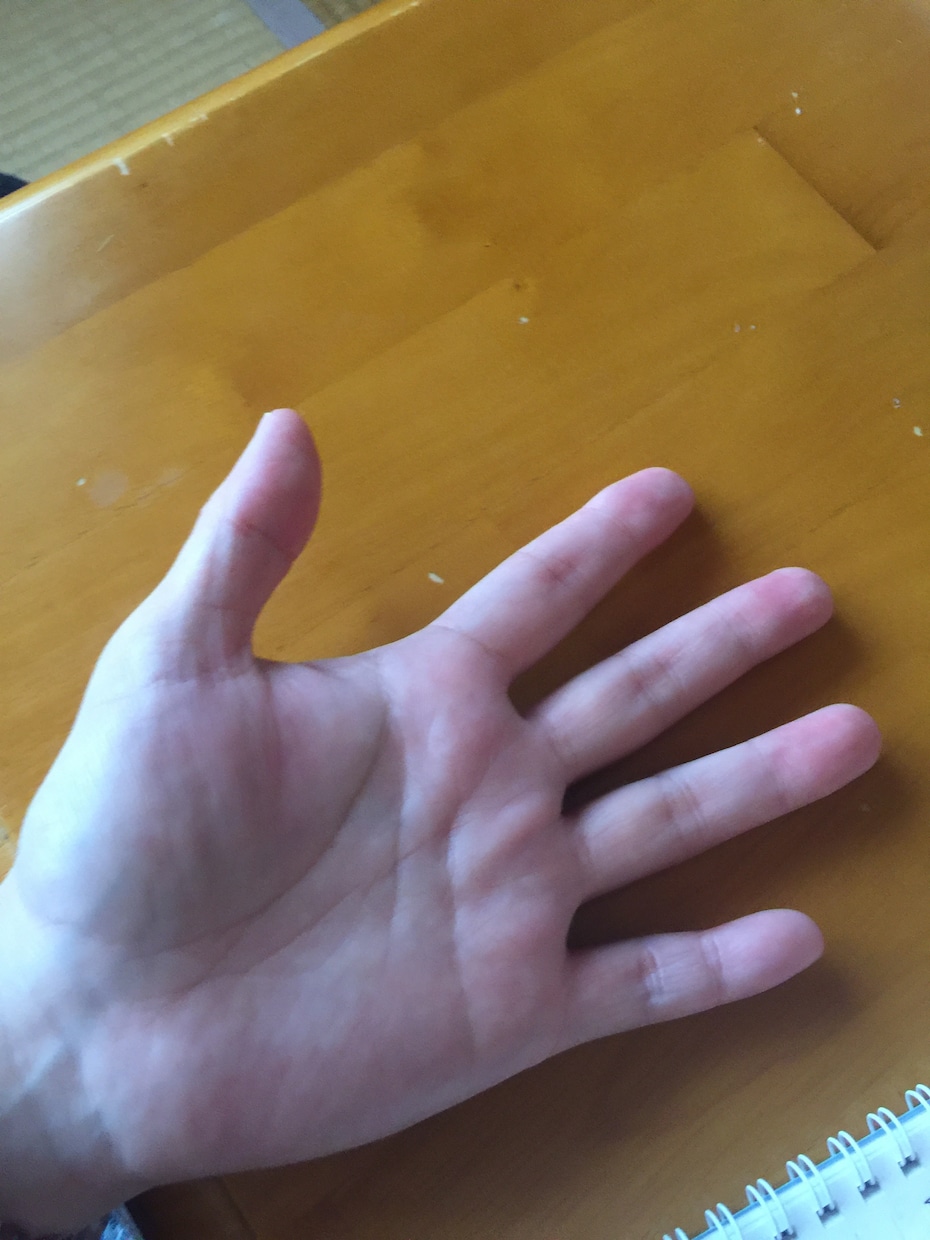 手荒れの相談のります ようやく14年目で手荒れが克服できました イメージ1