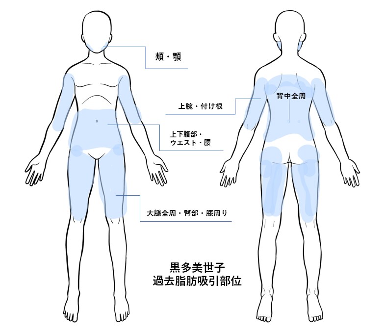 脂肪吸引を受ける前に！貴方のギモンにお答えします 6.6ℓの全身脂肪吸引した経験者によるリアルな話伝えます イメージ4