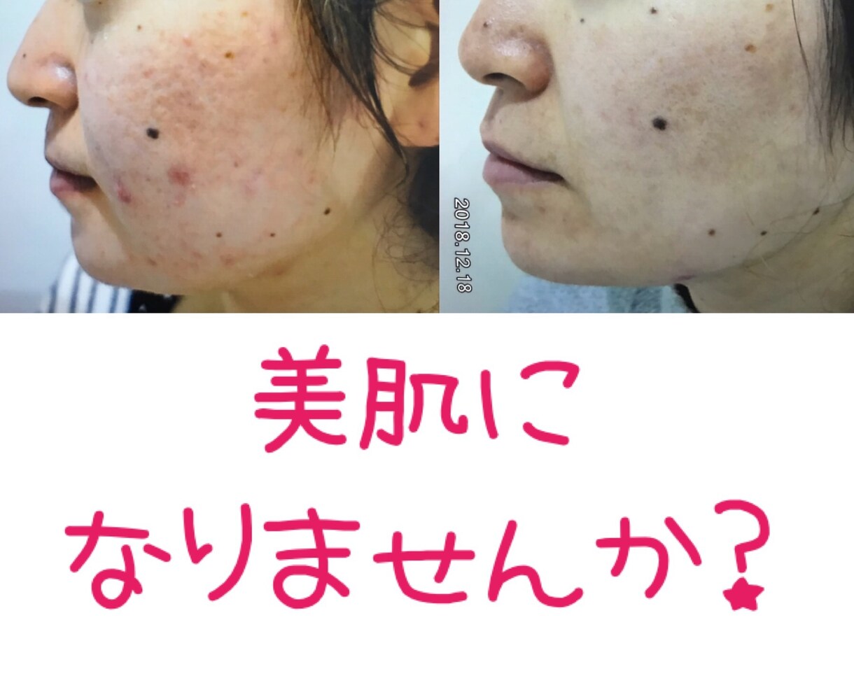 限定20名☆肌質にあったスキンケアお伝えします 500人以上の肌を肌専門サロンにてカウンセリング実績 イメージ4