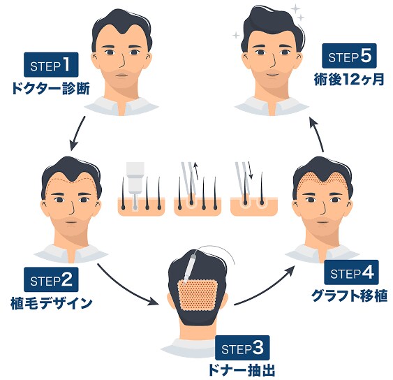 植毛について、実体験に基づきアドバイスします 育毛剤、頭皮ケアはほぼ無意味！AGA治療薬は一生継続必要 イメージ2