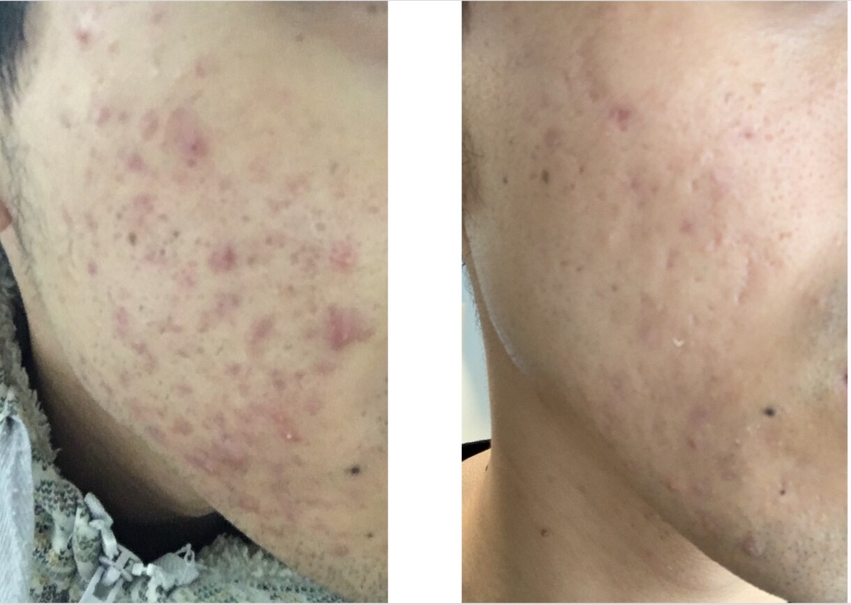 お悩みの肌トラブルを解決いたします 自分の【ニキビ肌激変経験】から肌トラブルのお悩み乗ります イメージ1
