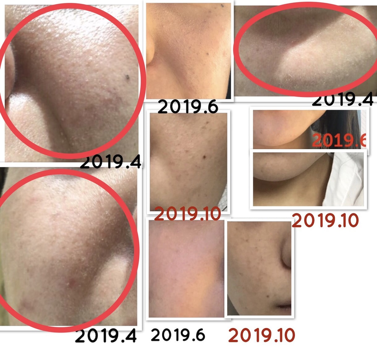 美肌へ肌悩みのカウンセリング➕肌改善方法教えます プロ資格講師自宅ケア改善指導ニキビ肌荒れ改善法伝授 イメージ2