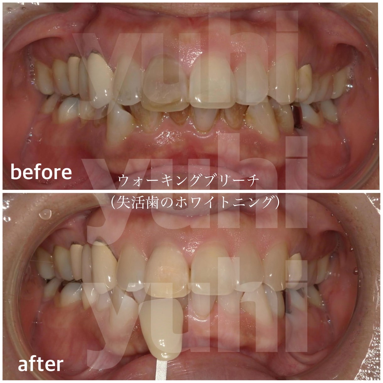 ホワイトニングの説明をします 種類があります！自分にピッタリな適切なホワイトニングを選択 イメージ7