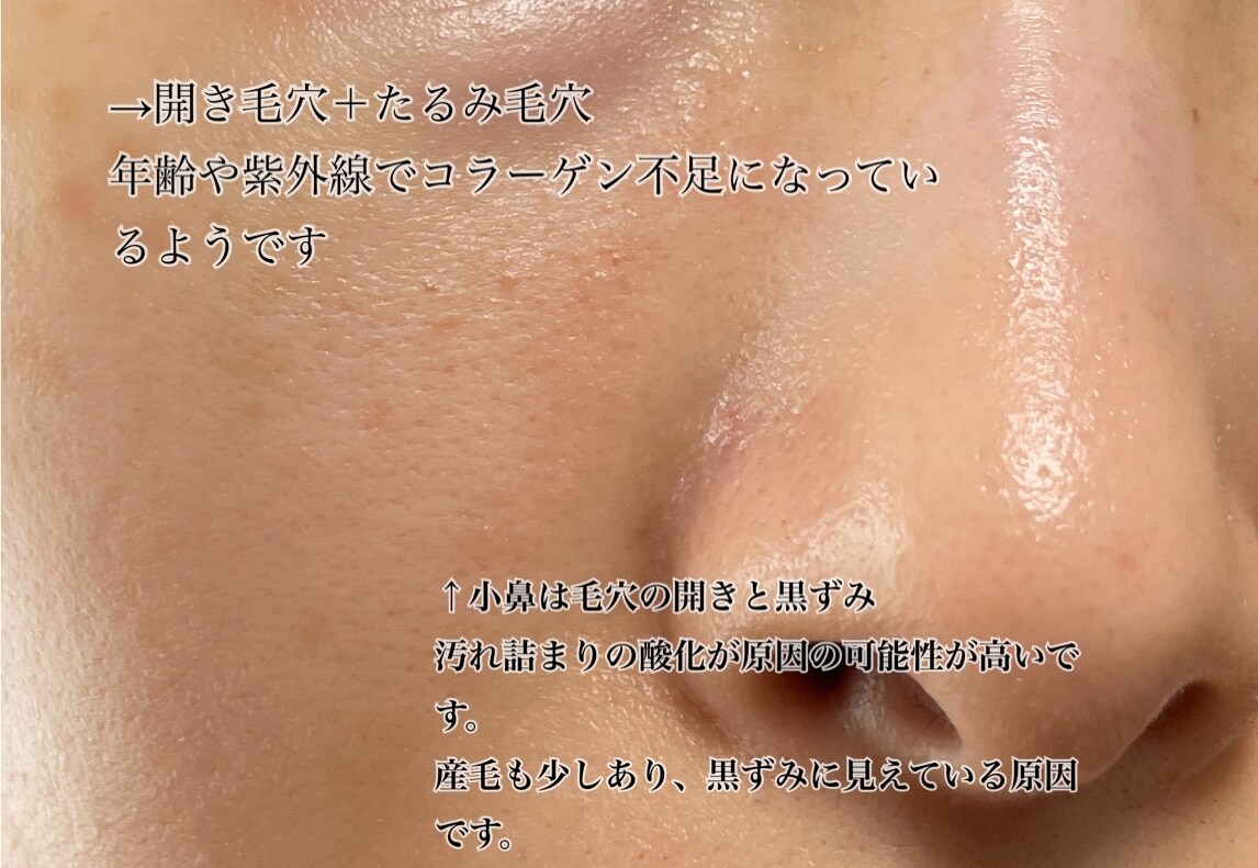 毛穴専門店エステティシャンが毛穴タイプ診断をします あなたの毛穴タイプをお伝えし美肌へのお手伝いをします。 イメージ2