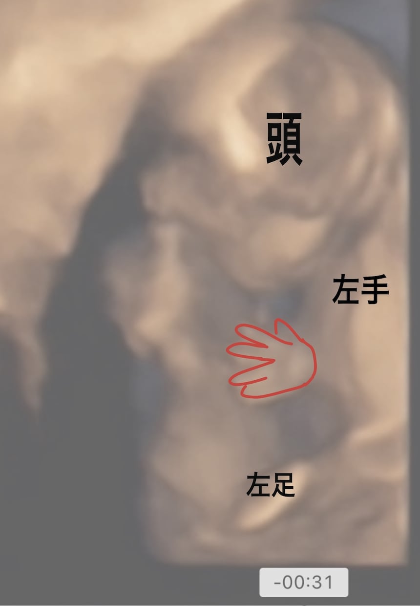 専門医がエコー全体を画像付きで解説します これはなにを見ているのかなど、胎児エコーを詳しく解説。 イメージ8