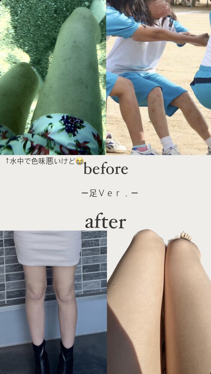 アトピーのお悩み聞きます 元15年アトピーだったアトピーカウンセラーがお話聞きます イメージ6