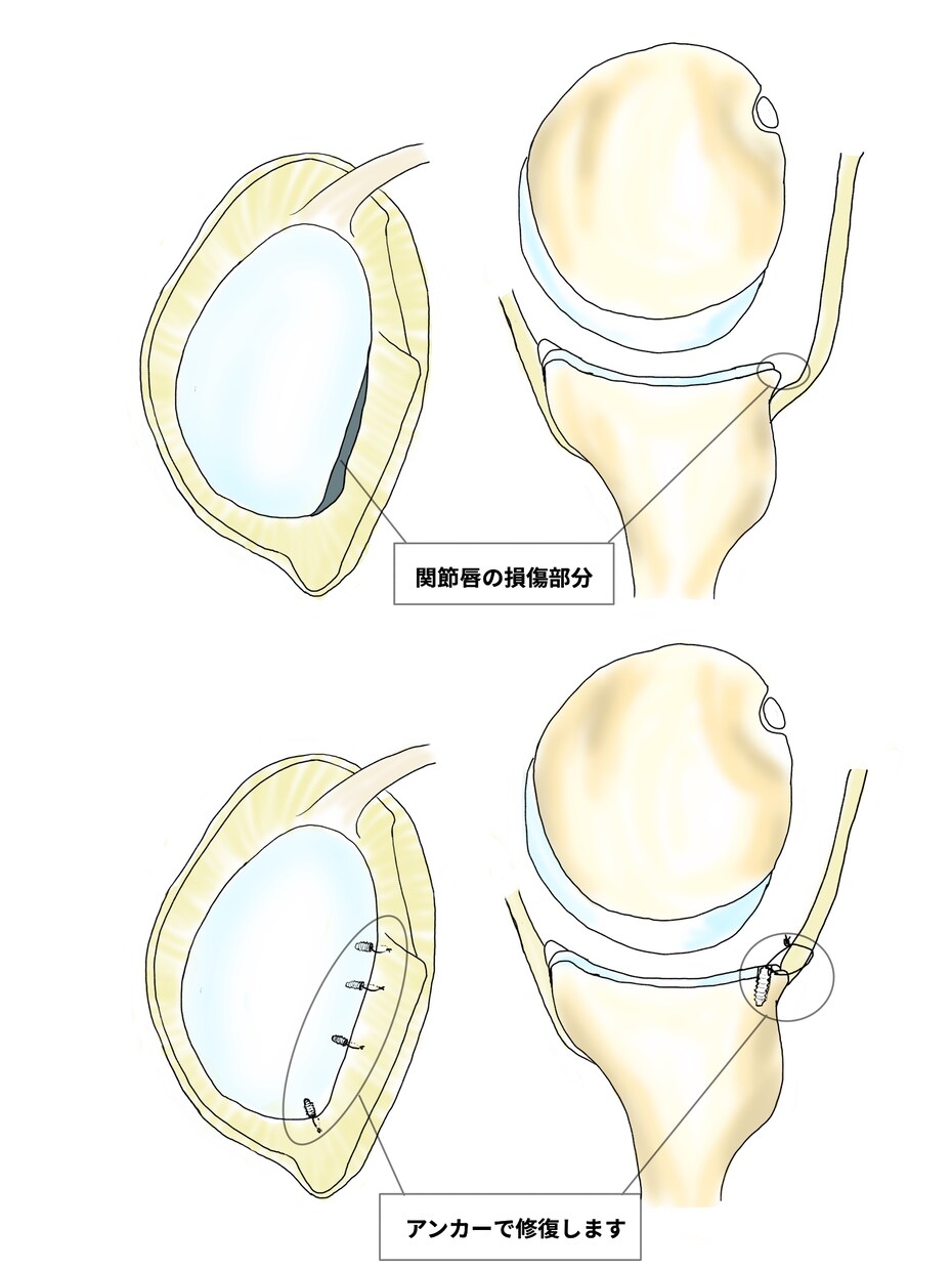 整形外科専門医が医療イラストを描きます 論文用シェーマや患者説明用イラストなどに！ イメージ8