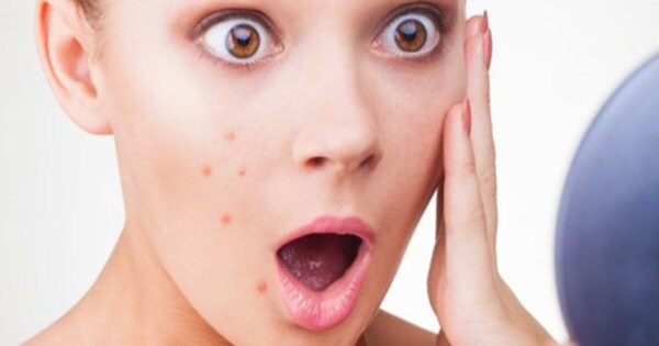 体質にあったニキビ・ニキビ跡の予防法を考えます 洗顔剤や食事を変えたくらいではニキビは防げません。 イメージ1