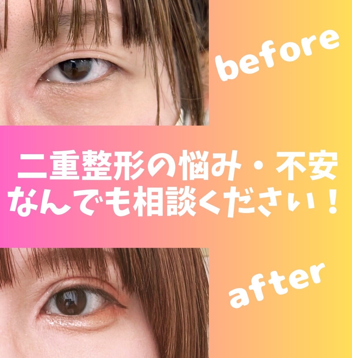 二重整形をしたいけど不安な方の話聞きます 一重の悪人顔の私が二重を手に入れて人生変わった整形談 イメージ1