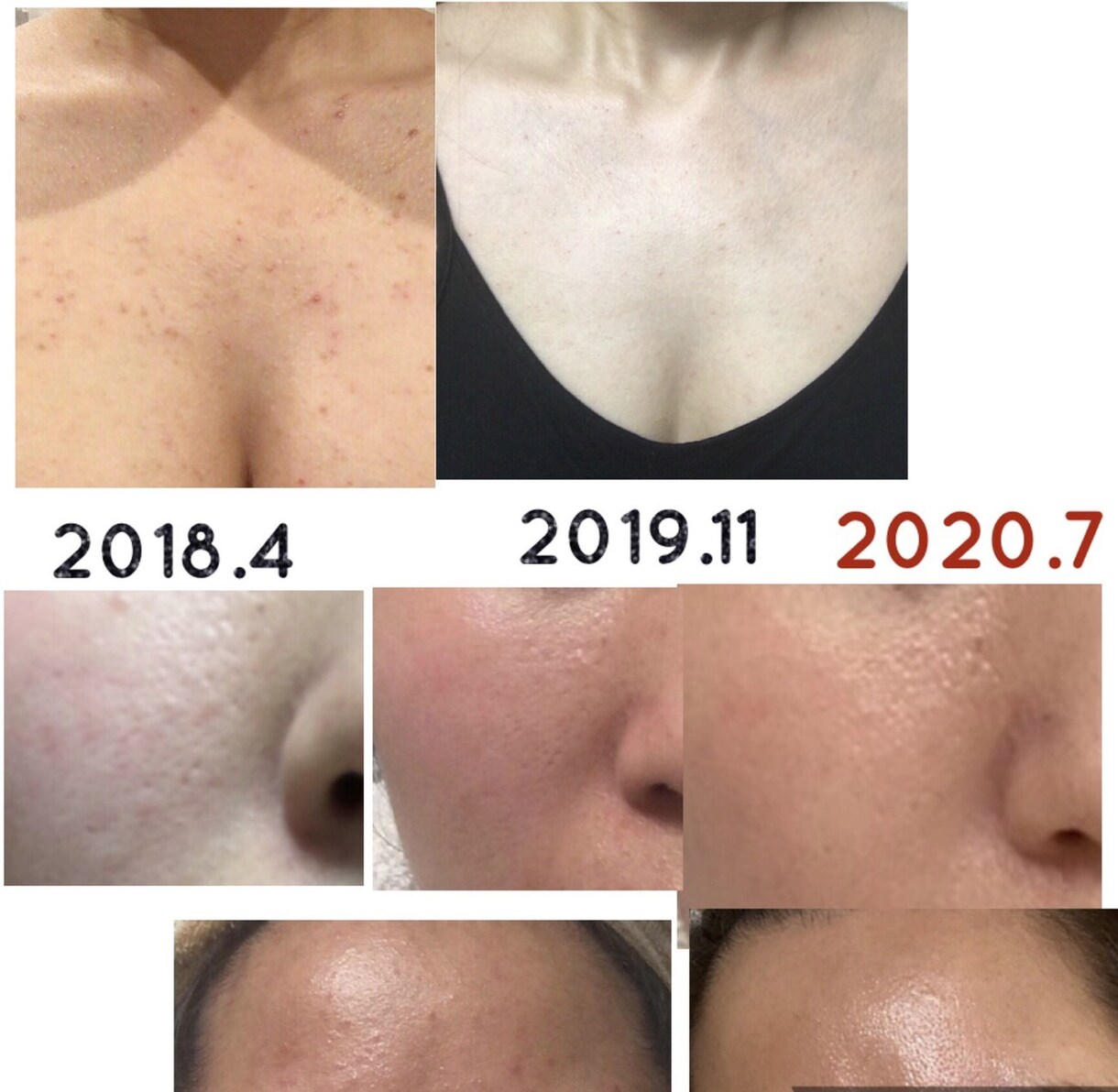美肌へ肌悩みのカウンセリング➕肌改善方法教えます プロ資格講師自宅ケア改善指導ニキビ肌荒れ改善法伝授 イメージ5