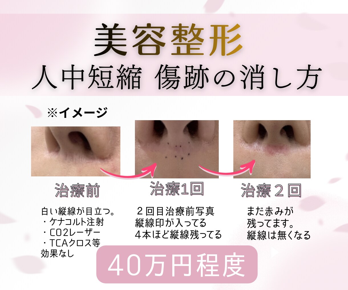 人中短縮の傷跡で悩んでる方❗️アドバイスします 鼻下の傷跡！この傷跡だけ消したかった！ イメージ1