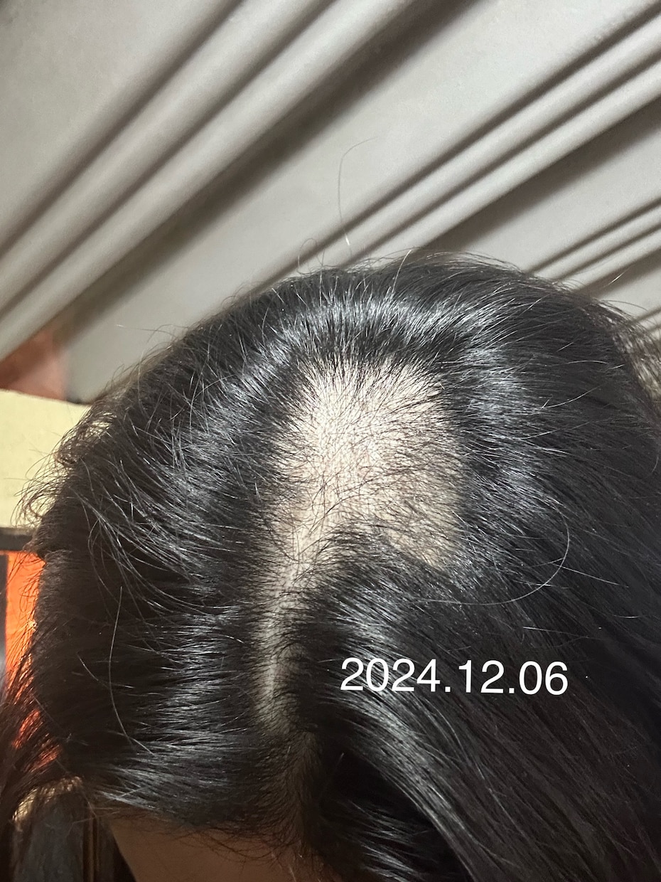 抜毛症専門！あなたの苦しみに寄り添います 私の経験談を詳しくお話します。 イメージ2