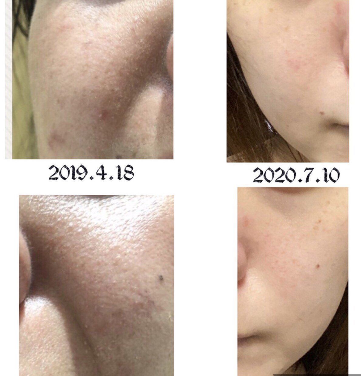 美肌へ肌悩みのカウンセリング➕肌改善方法教えます プロ資格講師自宅ケア改善指導ニキビ肌荒れ改善法伝授 イメージ1
