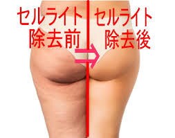 悪魔のセルライトは絶対イヤという方にオススメします セルライトの予防と防止策を分かりやすく解説しました。 イメージ1