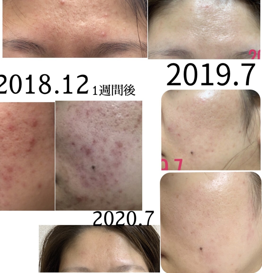 美肌へ肌悩みのカウンセリング➕肌改善方法教えます プロ資格講師自宅ケア改善指導ニキビ肌荒れ改善法伝授 イメージ6