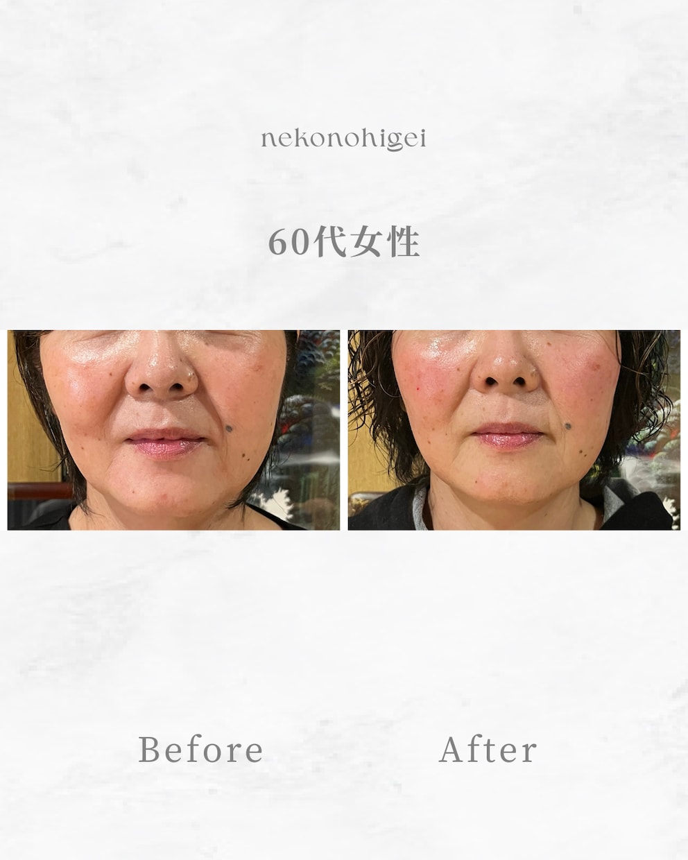 顔に鍼を打ってるだけ”から卒業できます お客様に変化を実感させる美容鍼の基礎からの打ち方 イメージ5