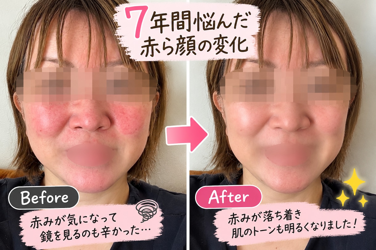 赤ら顔で悩むあなたのお話を聞きます 7年間悩んだ私が実体験をもとに寄り添います イメージ2