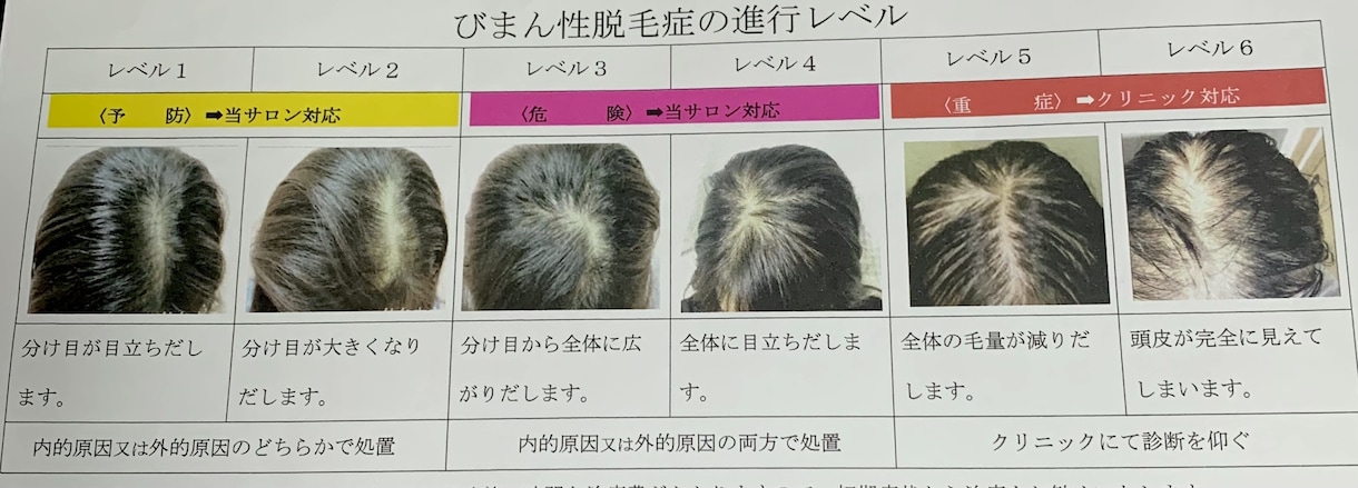 薄毛のあなたに寄り添います 本気で悩んでいる方へ！最後の砦としてご活用下さい。 イメージ2