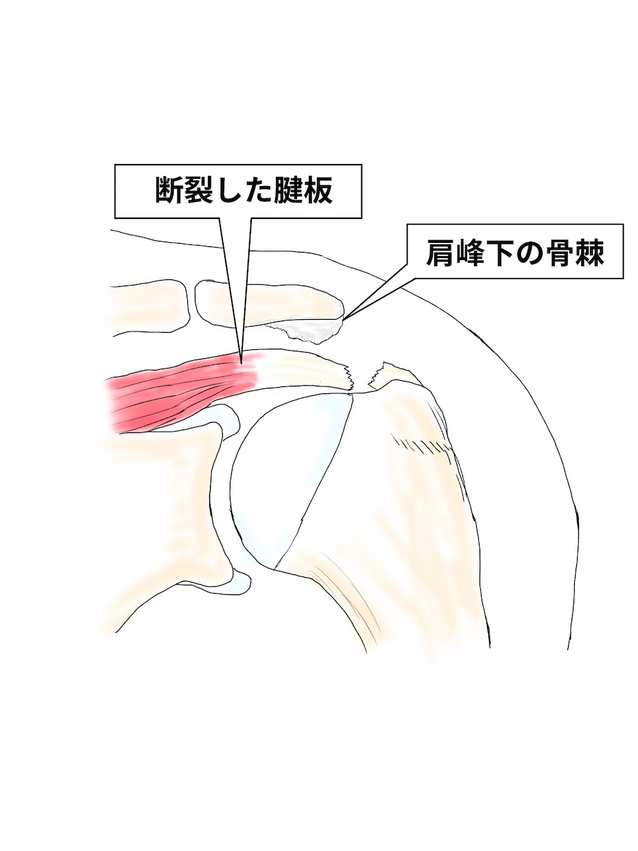 整形外科専門医が医療イラストを描きます 論文用シェーマや患者説明用イラストなどに！ イメージ7