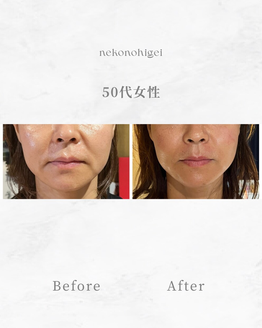 顔に鍼を打ってるだけ”から卒業できます お客様に変化を実感させる美容鍼の基礎からの打ち方 イメージ4