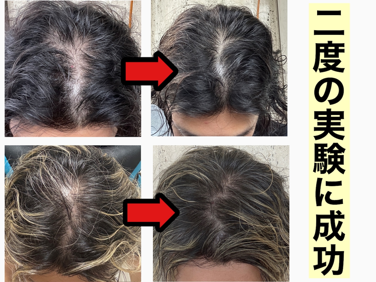 男性限定⚠️薄毛を改善させる方法をご提供いたします メンズの薄毛を徹底改善✨9割の増毛効果の実績✅ イメージ2